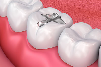Anne Eckhoff, DMD | Dentures, Invisalign reg  and Implant Dentistry