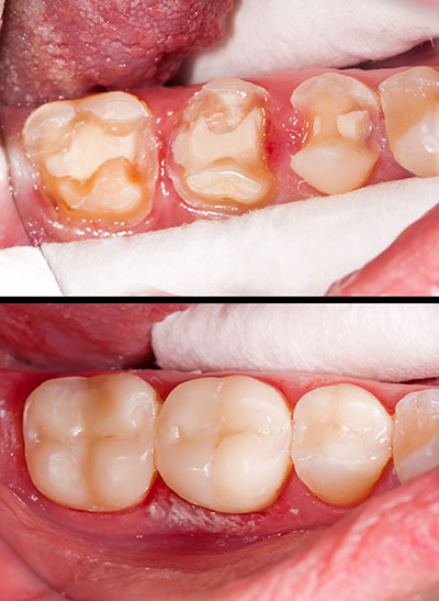 Anne Eckhoff, DMD | Pediatric Dentistry, Root Canals and Dentures