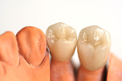 Anne Eckhoff, DMD | Teeth Whitening, Crowns  amp  Caps and Extractions
