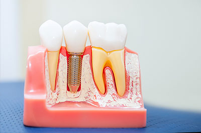 Anne Eckhoff, DMD | Teeth Whitening, Invisalign reg  and Cosmetic Dentistry