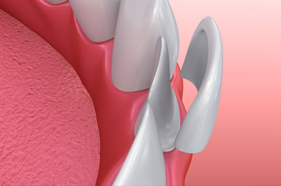 Anne Eckhoff, DMD | Crowns  amp  Caps, Dental Bridges and Teeth Whitening