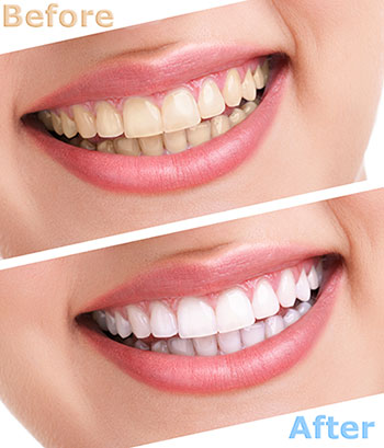 Anne Eckhoff, DMD | Crowns  amp  Caps, Dental Cleanings and Root Canals